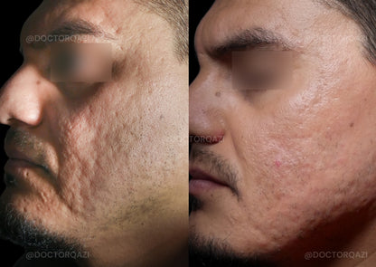 Acne Scar Consultation with Dr. Qazi