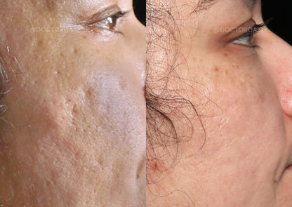 Acne Scar Consultation with Dr. Qazi