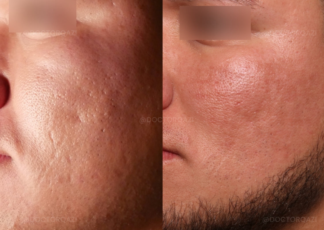 Acne Scar Consultation with Dr. Qazi