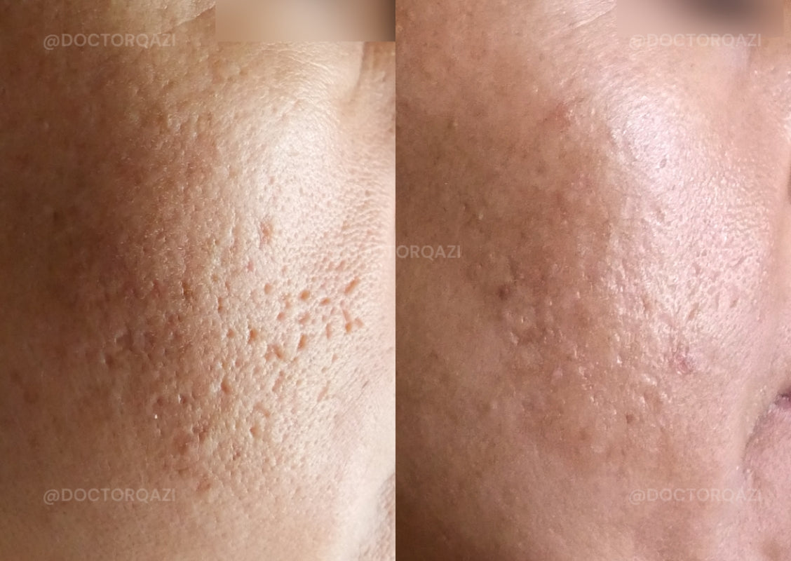 Acne Scar Consultation with Dr. Qazi