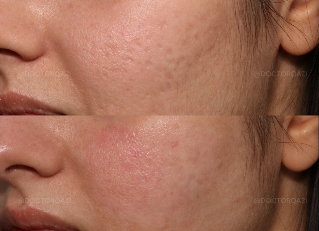 Acne Scar Consultation with Dr. Qazi