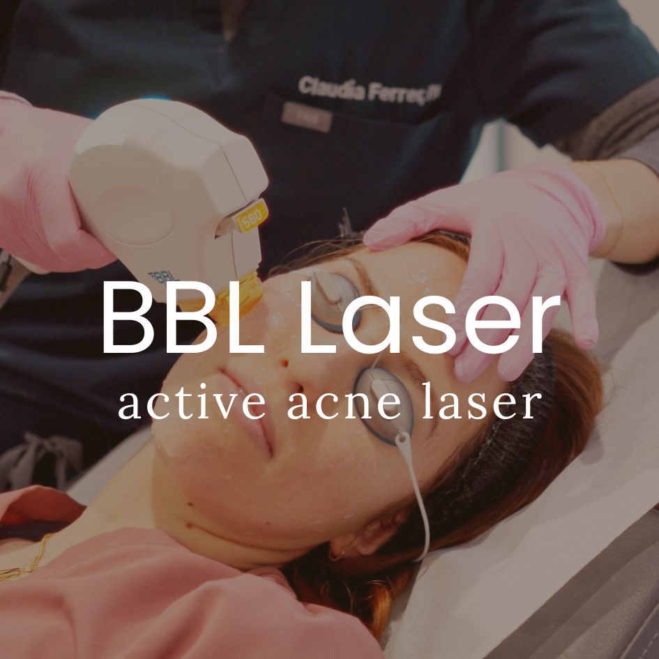 Active Acne Treatment with Broadband Light Therapy