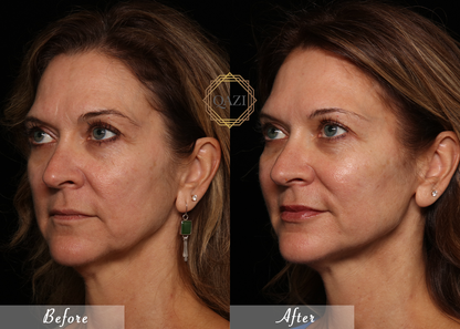 Jawline Enhancement Filler Treatment