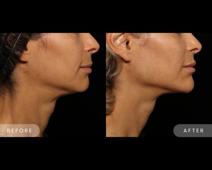 Chin Enhancement Filler Treatment