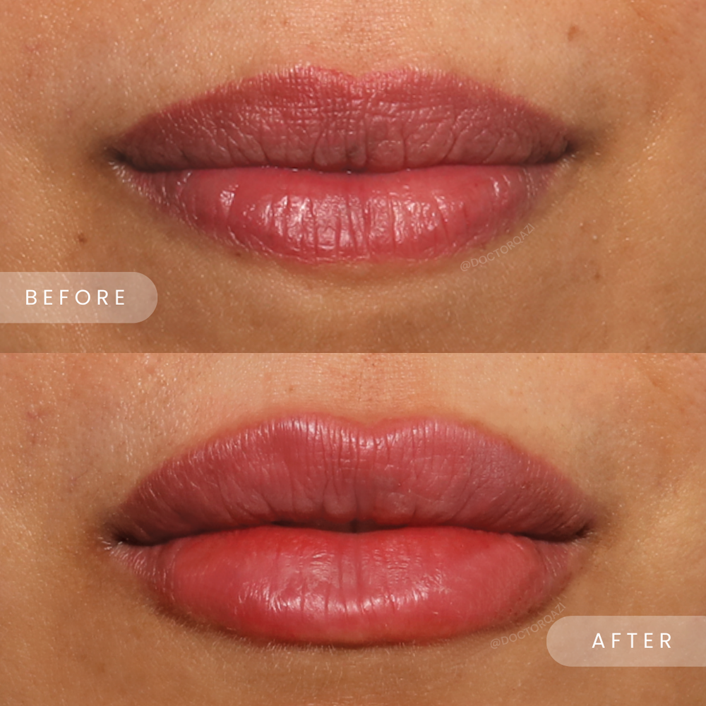 Lip Filler Treatment