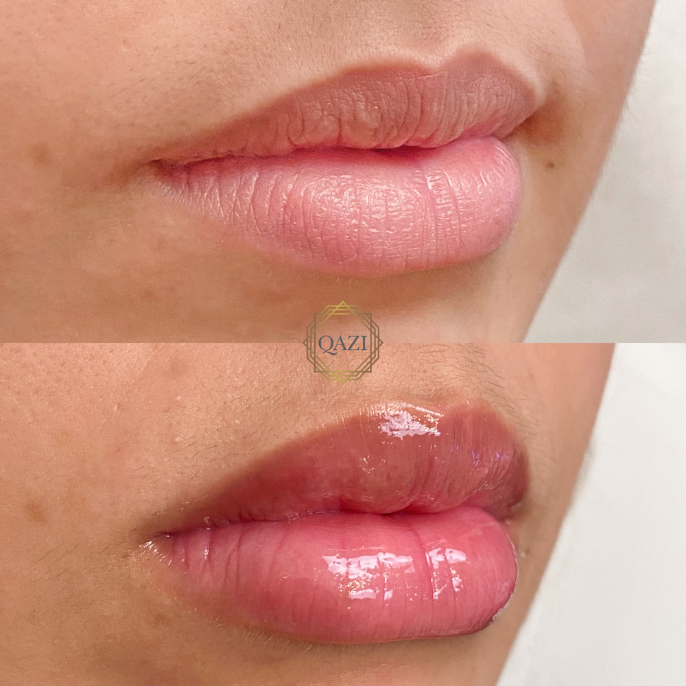 Academia Qazi - Relleno Para Labios