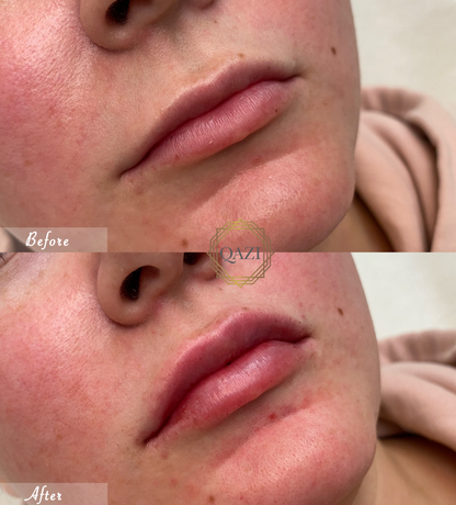 Lip Filler (Qazi Academy)