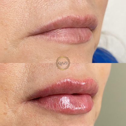 Lip Filler (Qazi Academy)