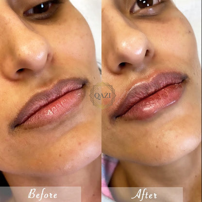 Lip Filler (Qazi Academy)