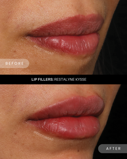 Lip Filler Treatment