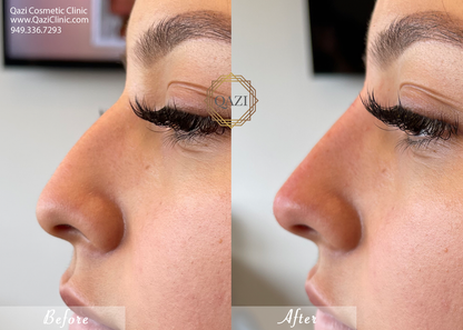 Nose Filler Profile Refinement