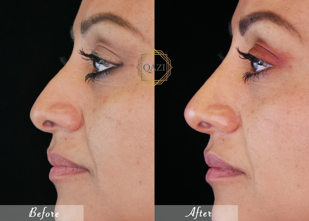 Nose Filler Profile Refinement