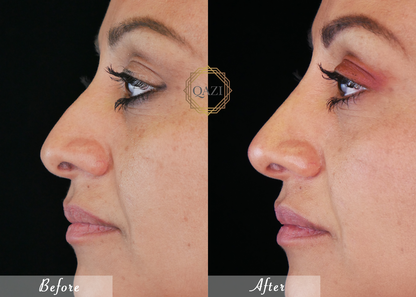 Nose Filler Profile Refinement