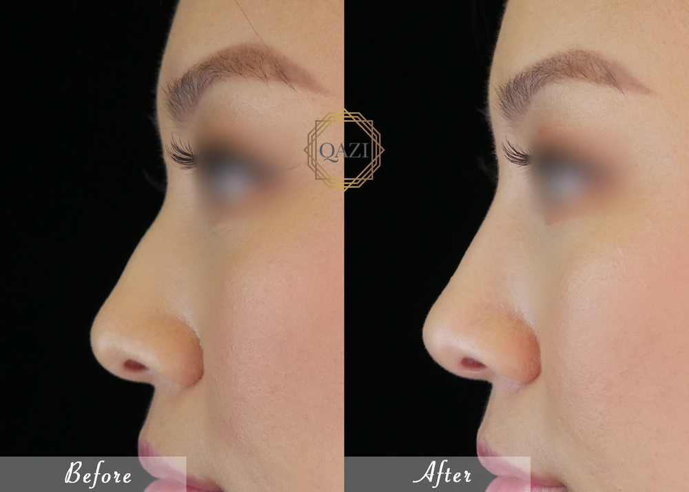 Nose Filler Profile Refinement