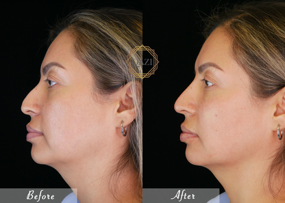 Nose Filler Profile Refinement