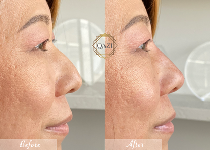 Nose Filler Profile Refinement