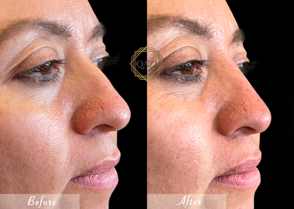 Nose Filler Profile Refinement