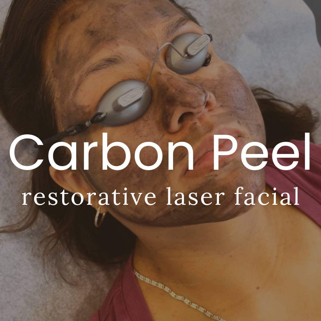 Carbon Laser Facial