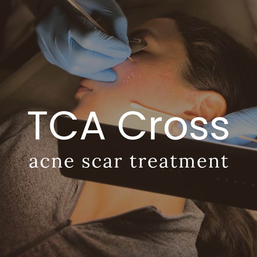 Tca Cross Scar Treatment Qazi Cosmetic Center