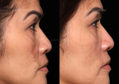 Pico Laser for Discoloration Repair