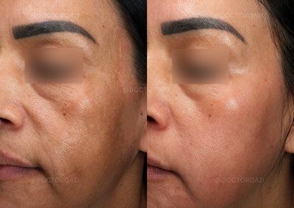 Pico Laser for Discoloration Repair