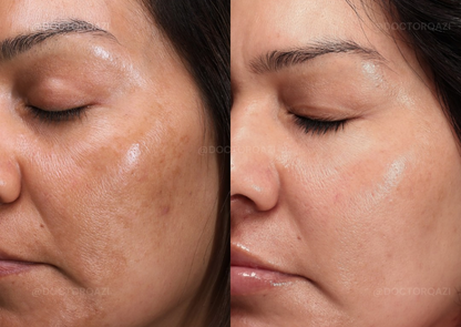 Pico Laser for Discoloration Repair