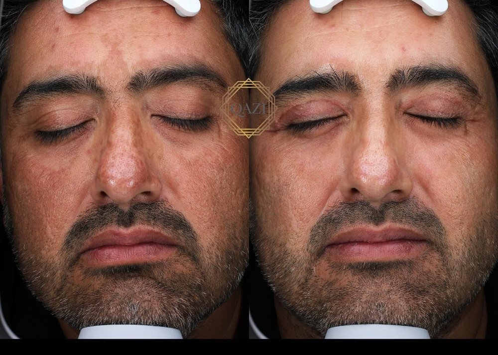 Pico Laser - Full-Face Treatment