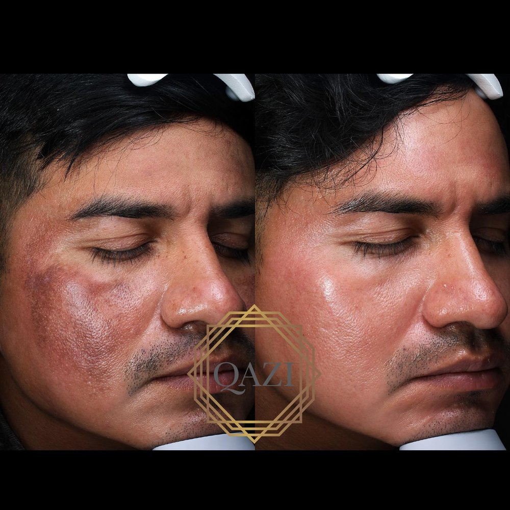 Pico Laser - Full-Face Treatment