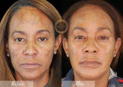 Pico Laser for Discoloration Repair