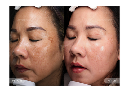 Pico Laser for Discoloration Repair