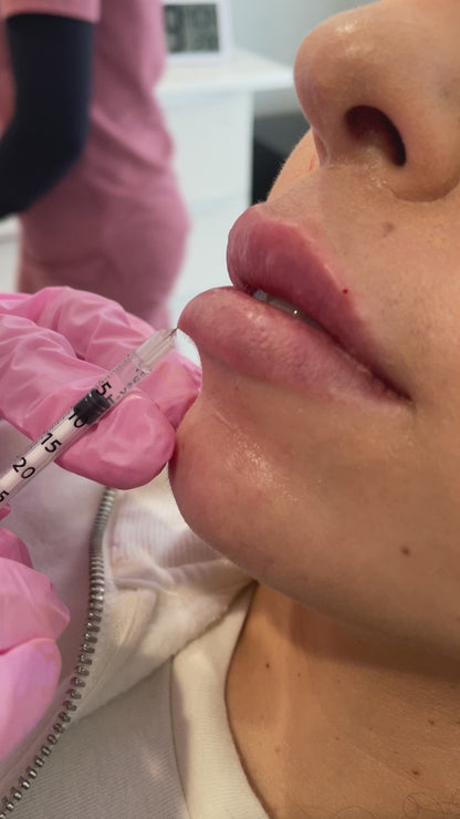 Lip Filler Treatment