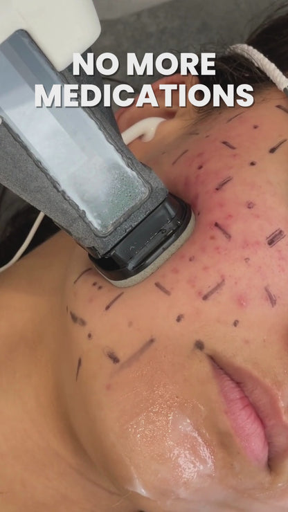 Accure Acne Laser Treatment