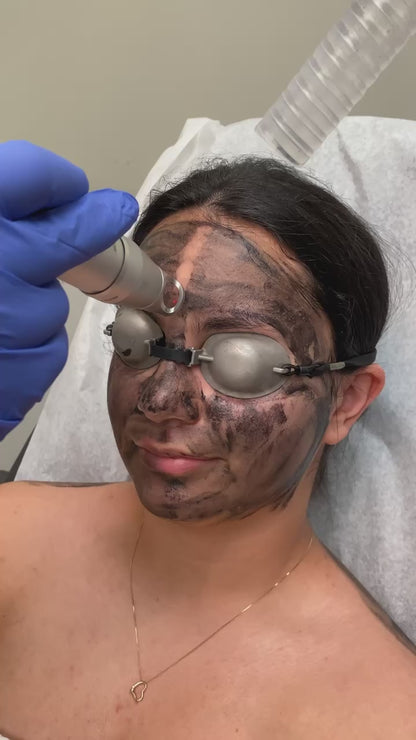 Carbon Laser Facial