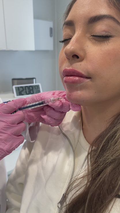 Chin Enhancement Filler Treatment