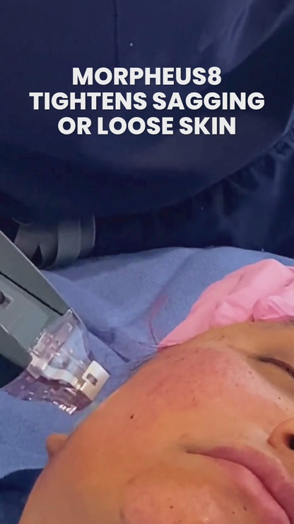 Morpheus8 Skin Tightening or Fat Reduction