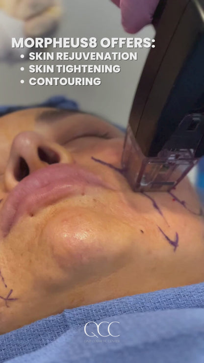 Morpheus8 Skin Tightening or Fat Reduction