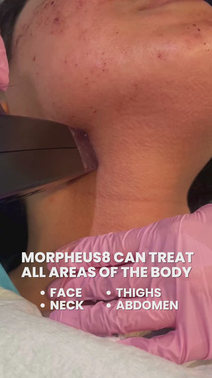 Morpheus8 Skin Tightening or Fat Reduction