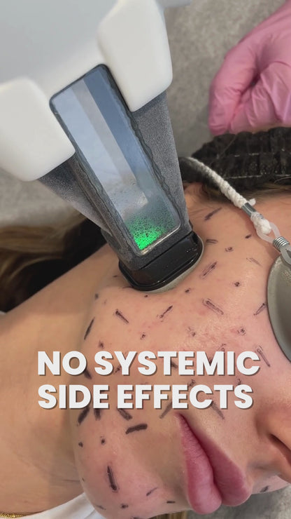 Accure Acne Laser Treatment