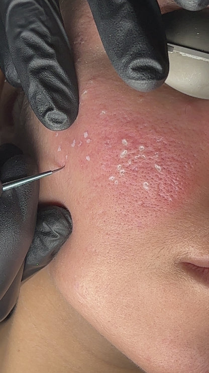 TCA Cross Acne Scar Treatment