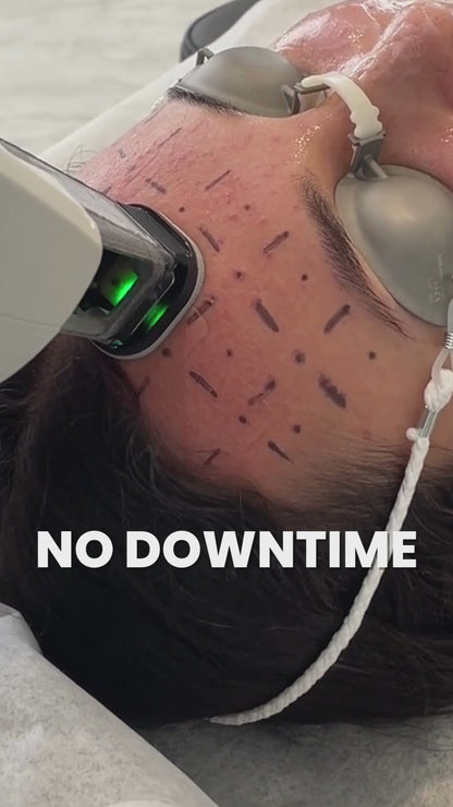 Accure Acne Laser Treatment