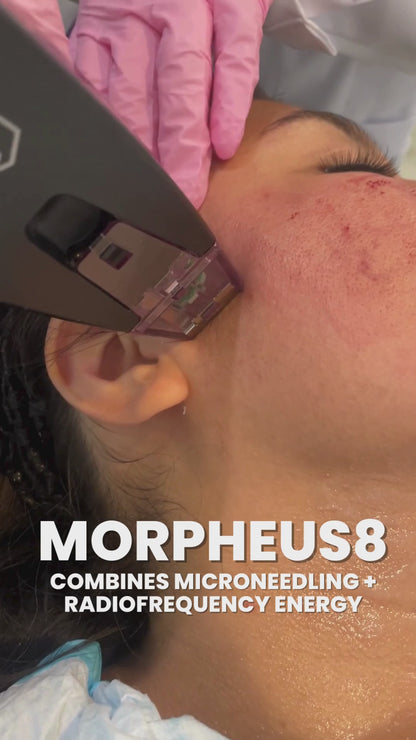 Morpheus8 Skin Tightening or Fat Reduction