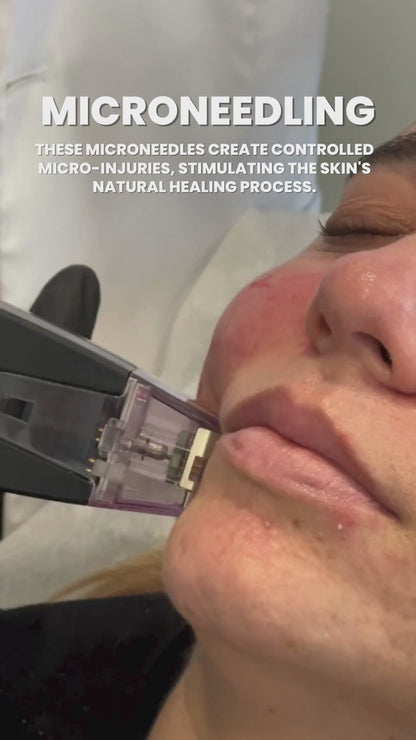 Morpheus8 Skin Tightening or Fat Reduction