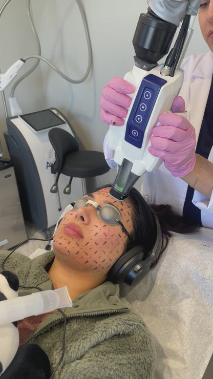 Accure Acne Laser Treatment