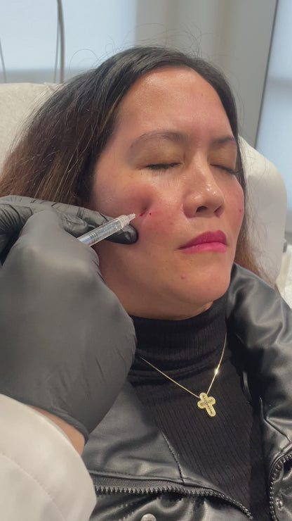 Cheek Enhancement Filler Treatment