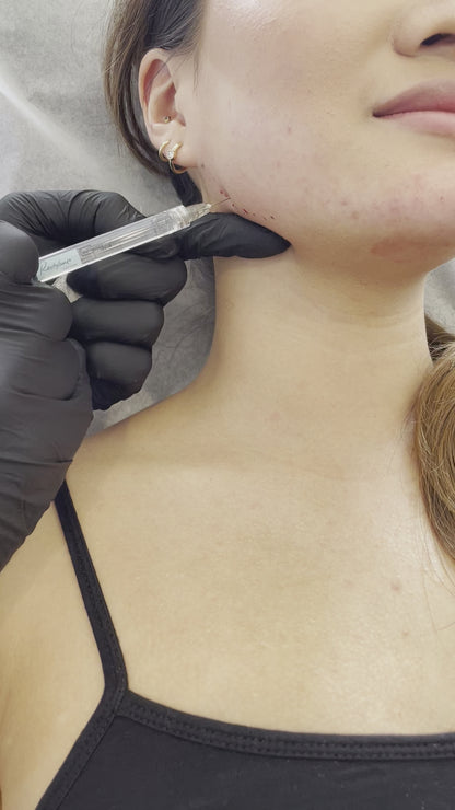 Jawline Enhancement Filler Treatment