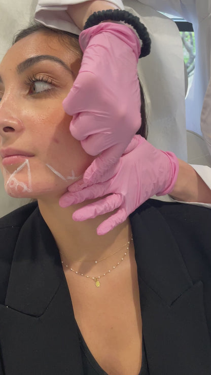 Jawline Enhancement Filler Treatment