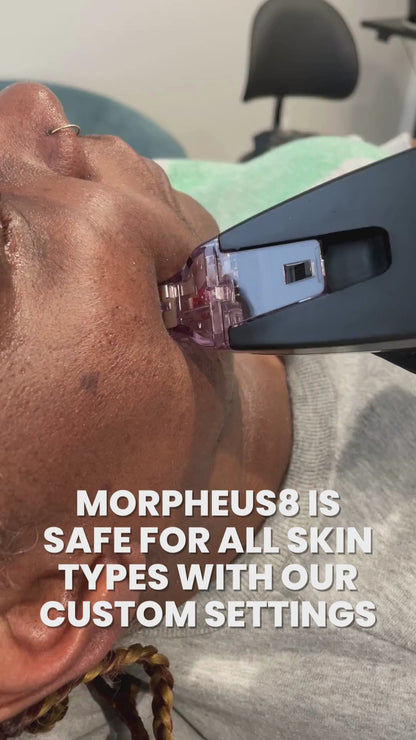 Morpheus8 Skin Tightening or Fat Reduction