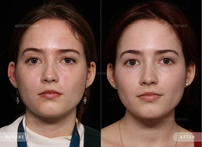 Rosacea Calming Laser Treatment