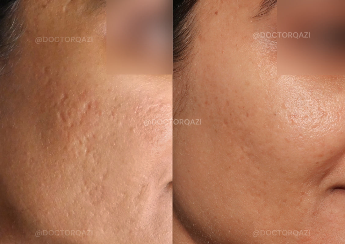 TCA Cross Acne Scar Treatment