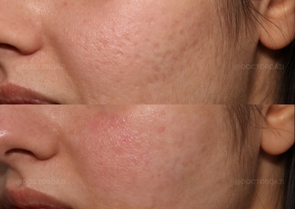 TCA Cross Acne Scar Treatment